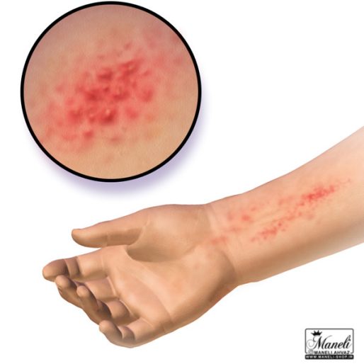 حساسیت پوستی به بدلیجات